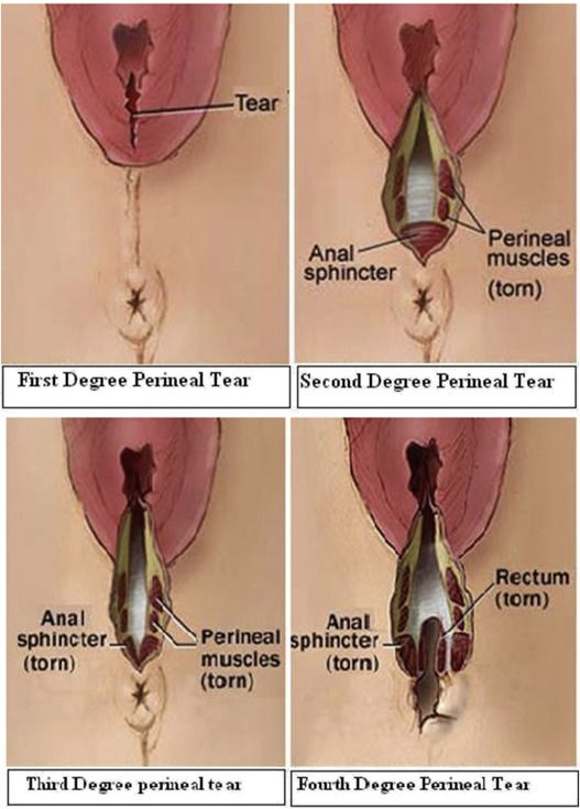 Damage to anal sphincter