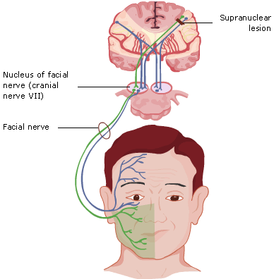 Zodiac reccomend Upper motor neurone facial palsy