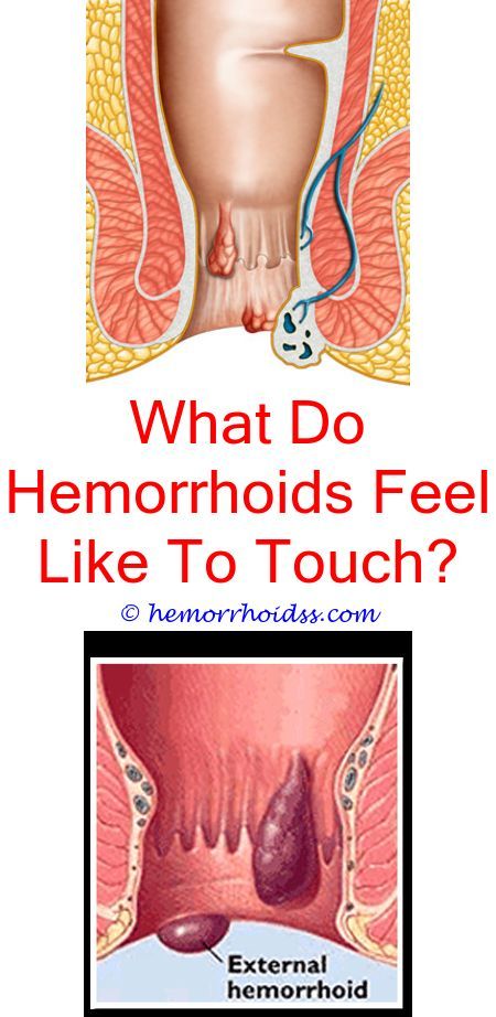 Hemroids anus feels like it is tight