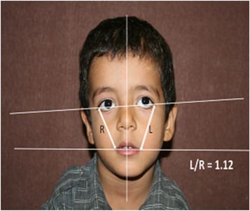 Cali reccomend Facial asymmetry in babies