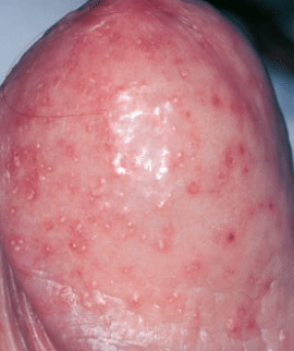 Small red bumps on penis head