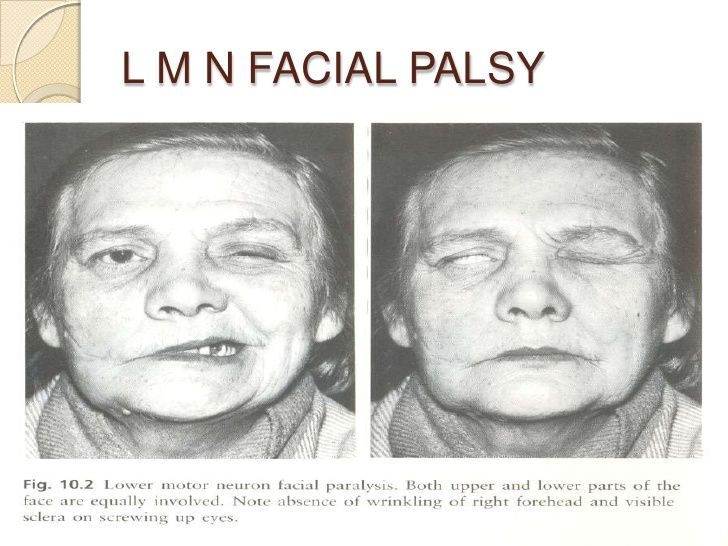 TigerвЂ™s E. reccomend Upper motor neurone facial palsy