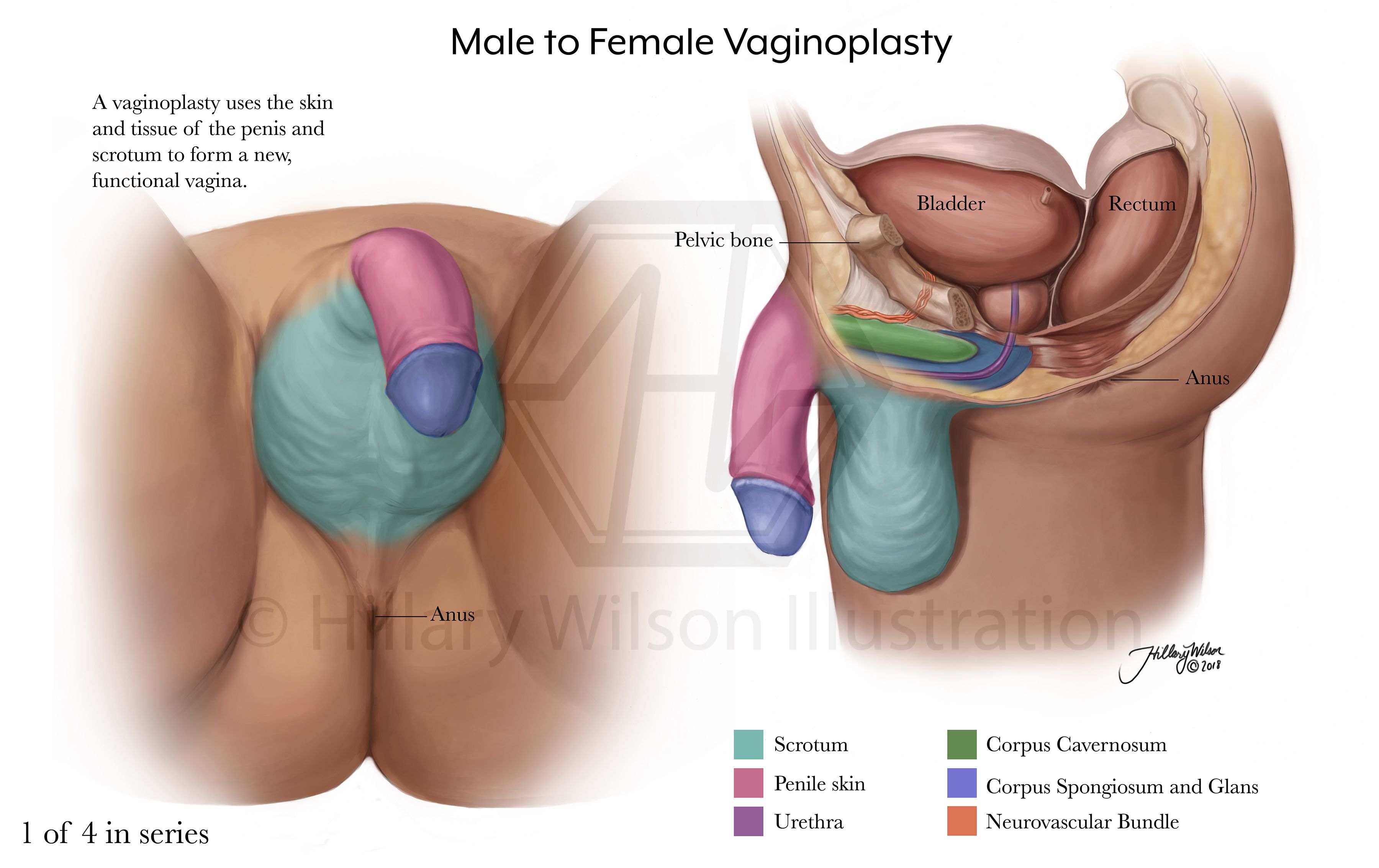 Photos of m2f transsexual vaginoplasty