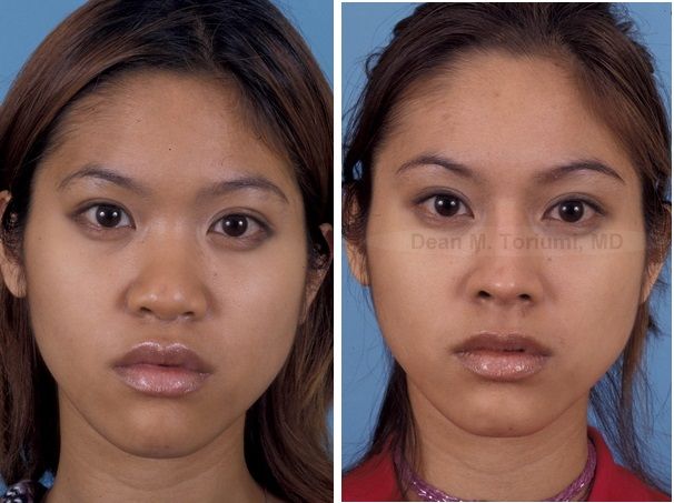 Asian nose surgery implants