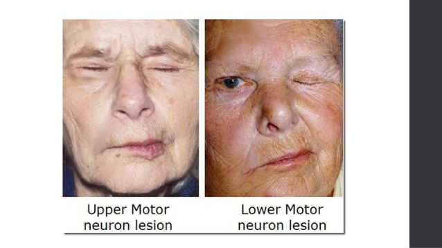 Roma reccomend Upper motor neurone facial palsy