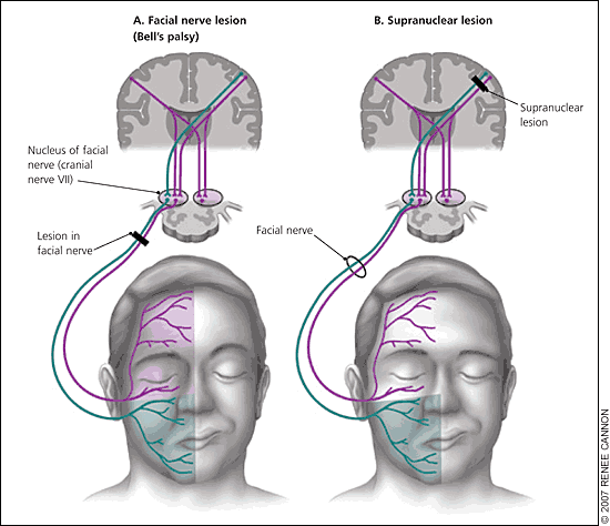 best of Nerve Peripheral palsy facial