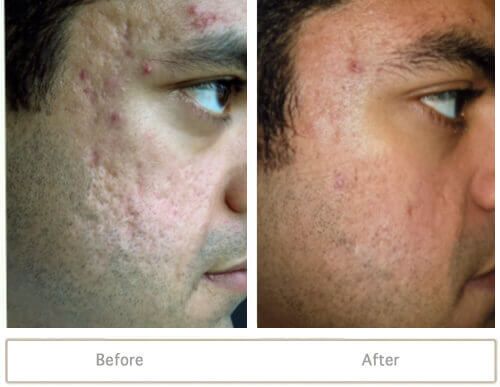 Lincoln reccomend Facial restoration from acne and dark spots