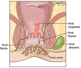 Anus genital warts