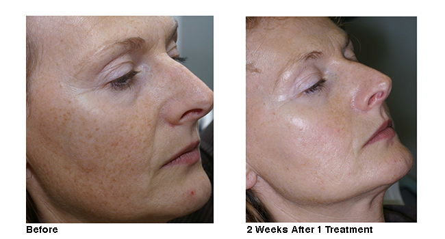 best of Brown spots facial Removing