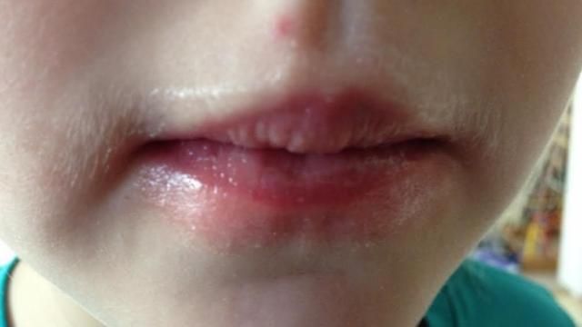 Orbit reccomend Facial red lip blotches