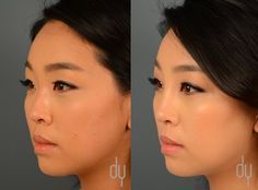 ATV reccomend Asian nose surgery implants