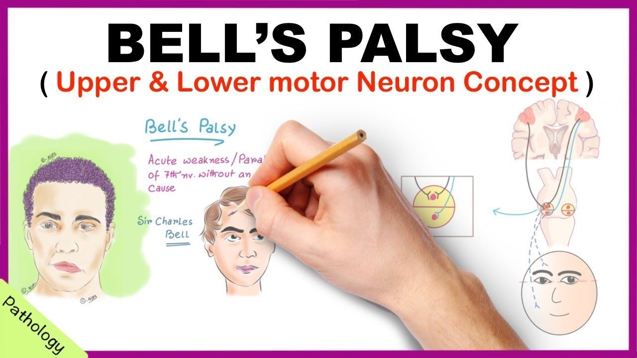 best of Motor neurone palsy Upper facial