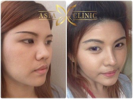 Dream D. reccomend Asian nose surgery implants