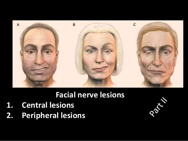 Peripheral facial nerve palsy