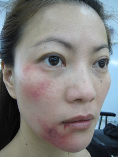 Arctic A. reccomend Facial contusion punch