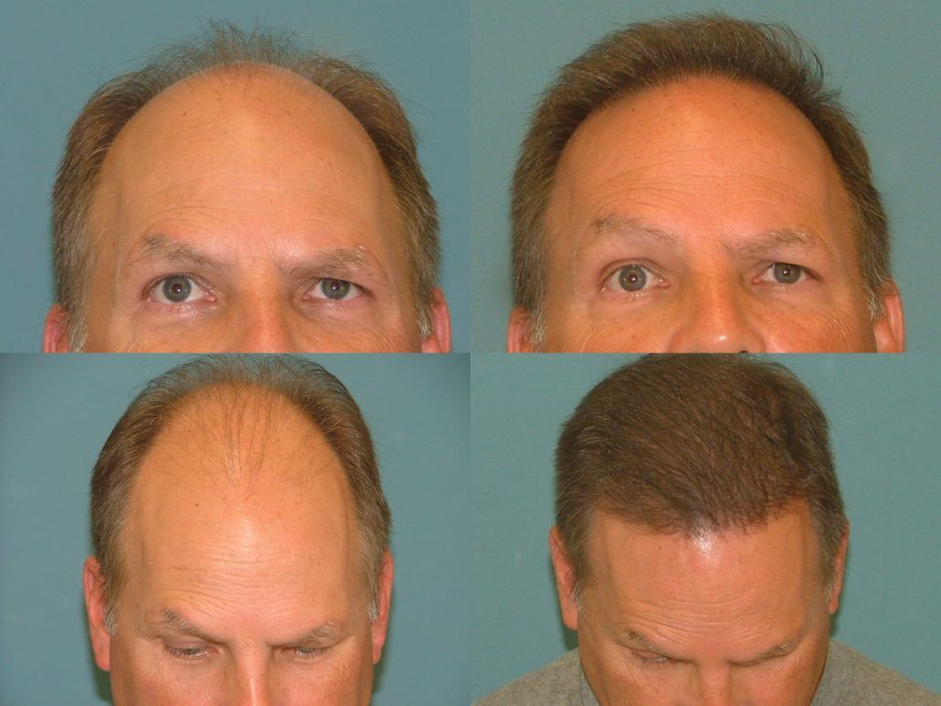 Specter reccomend Facial hair restoration west palm beach