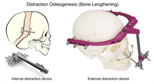 General reccomend Distraction osteogenesis of the facial skeleton