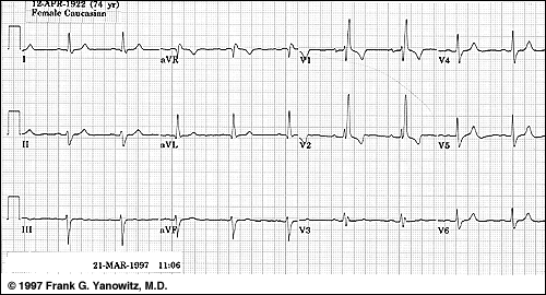 best of Of with bbb strip Ekg rsr