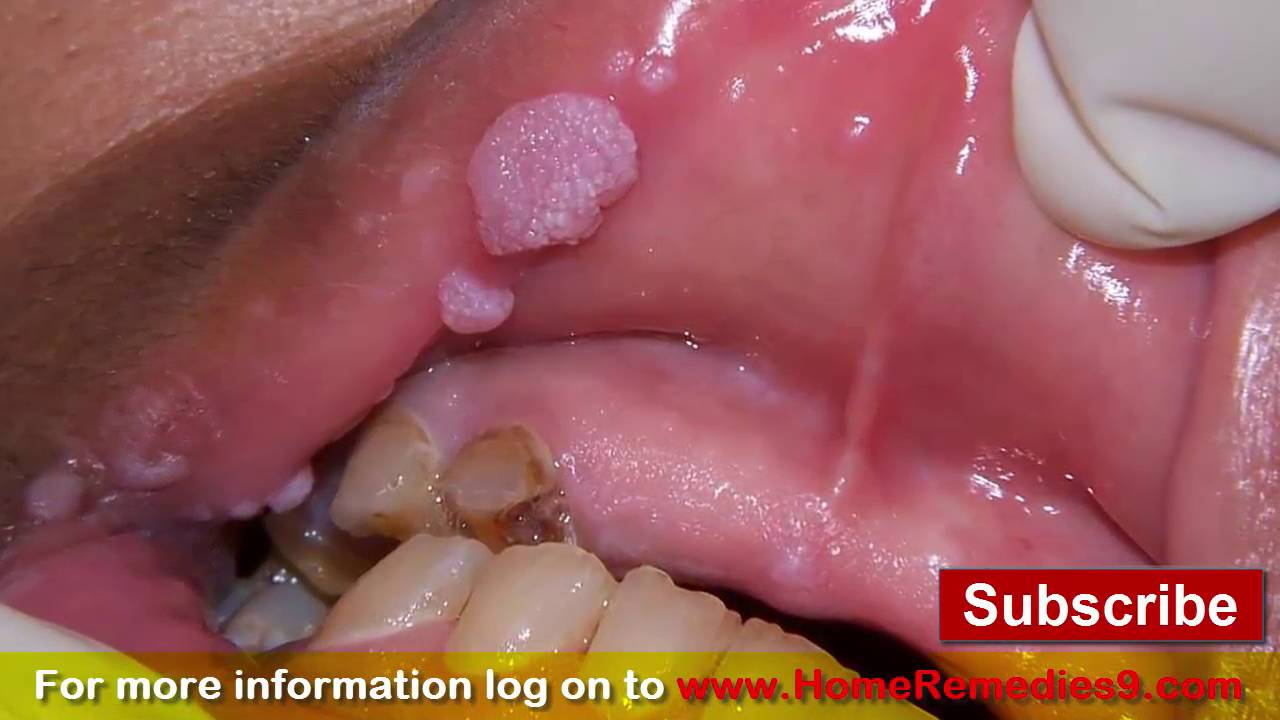 Genital in picture vagina wart