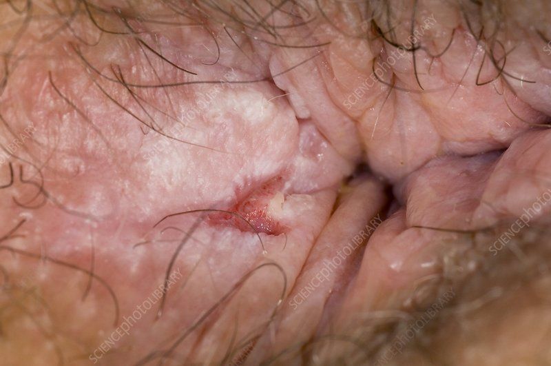 Anal fissure heal long
