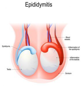 Drainage of sperm to treat epididymitis