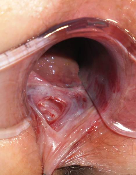 Multiple anal fissure