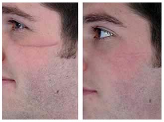 Plastic surgery facial scars