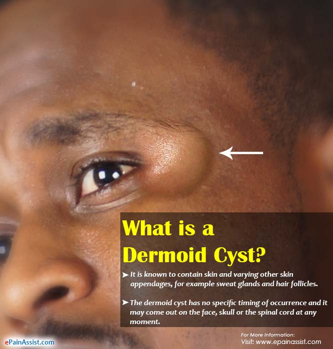Facial dermoid cyst