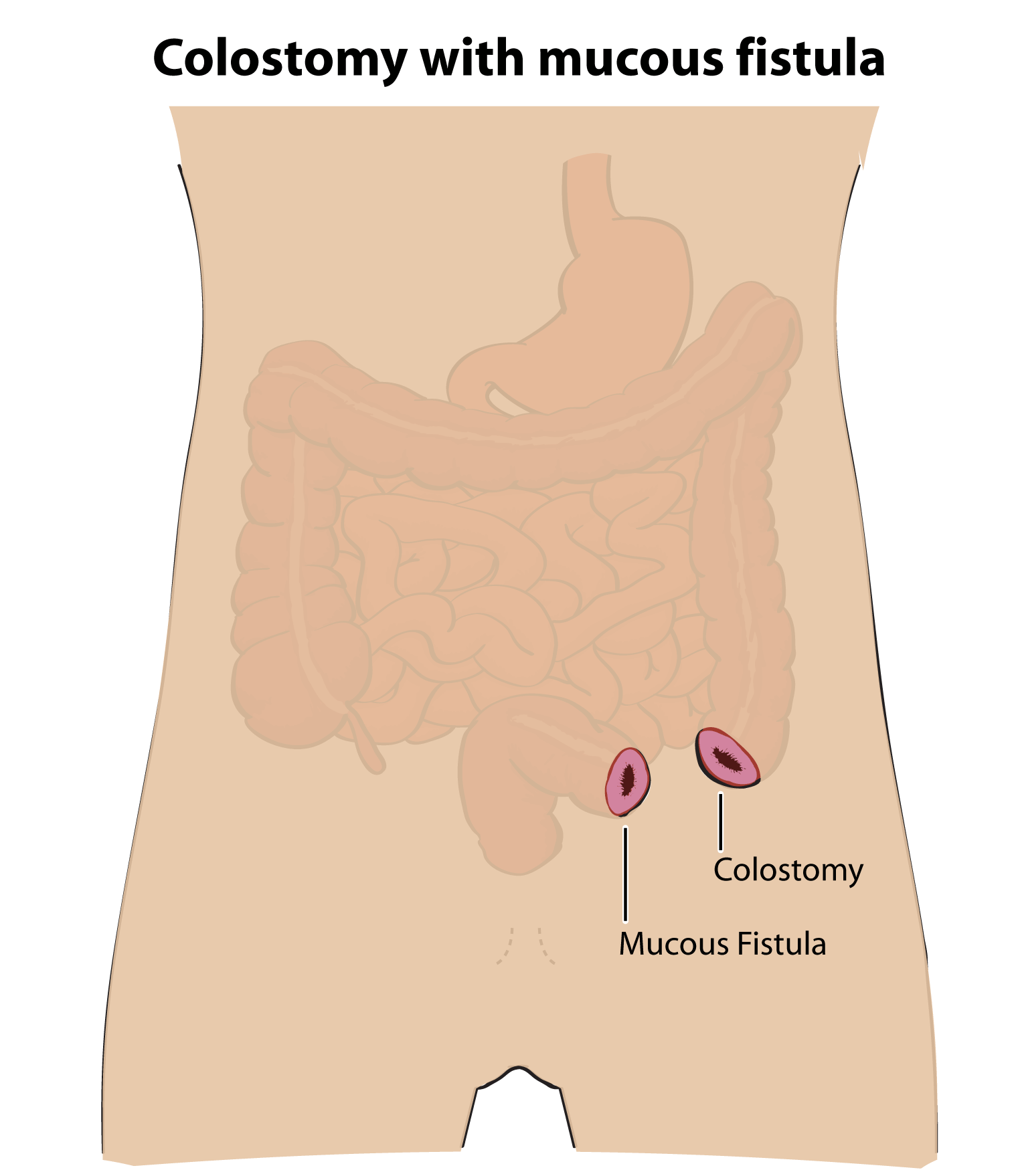 Anterior anus in infants