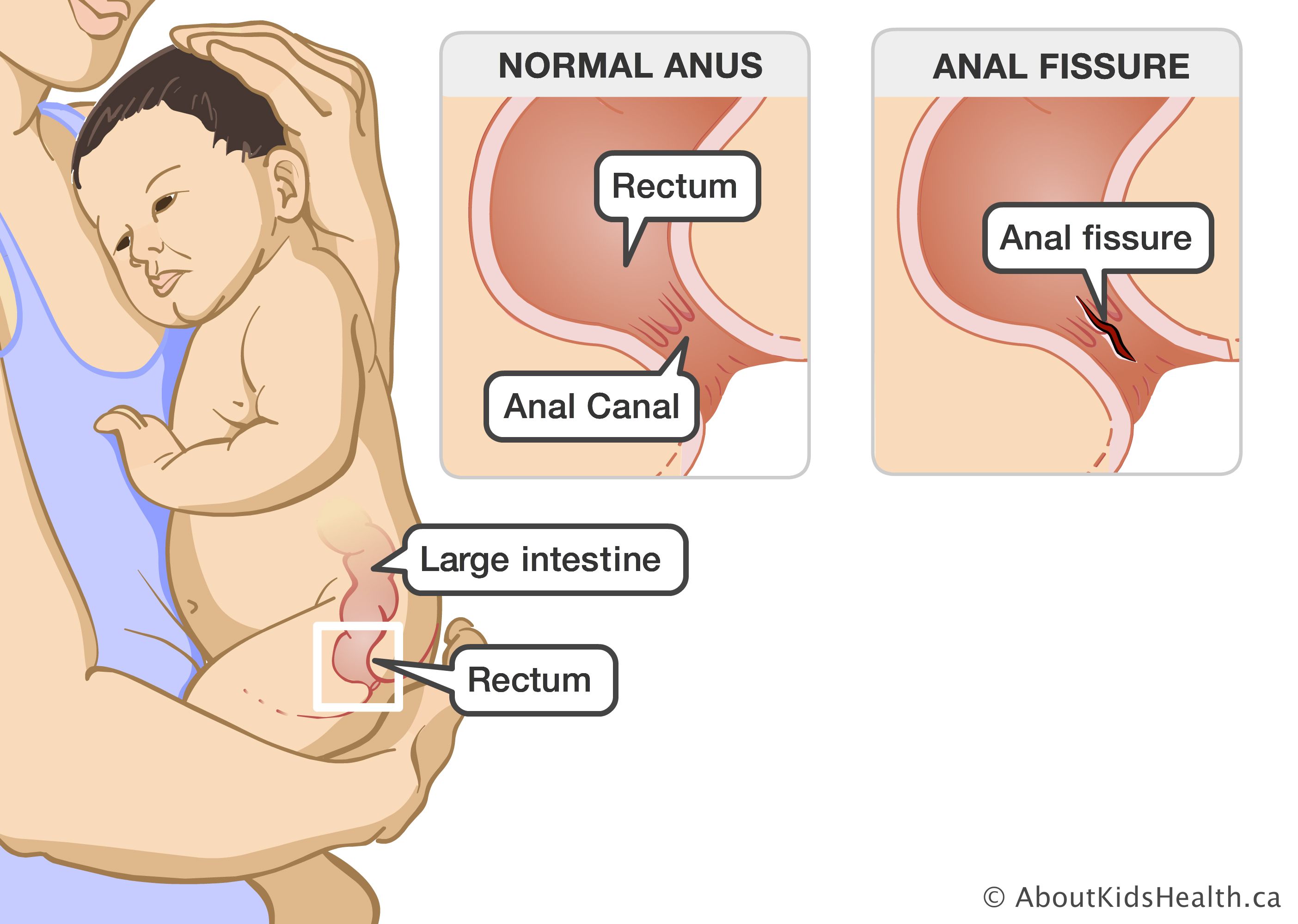 Venus reccomend Anterior anus in infants