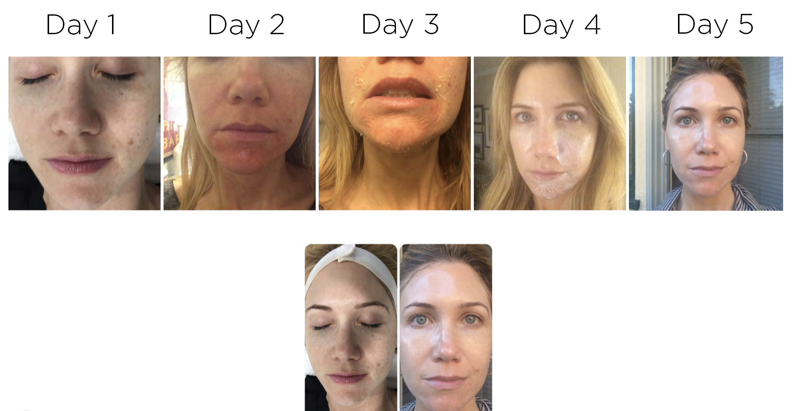 Mammoth reccomend Facial peel recovery