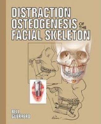 best of Osteogenesis facial the Distraction skeleton of