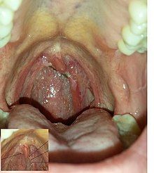 best of Removal complications wart Anal