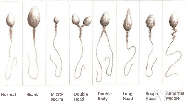 Apple reccomend Amorphous morphology of sperm