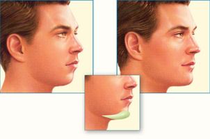 best of Of implants Cost facial
