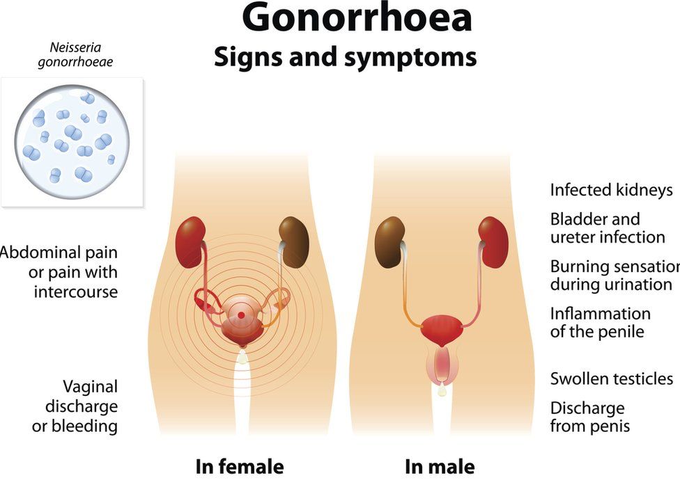 Lollipop reccomend Oral sex herpes gonorrhea