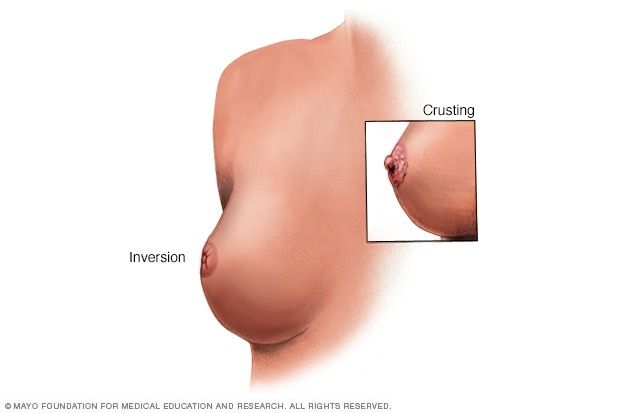 Lumps in boob after and abortion