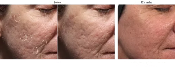 best of Dark and Facial spots acne restoration from