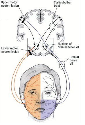 Stretch reccomend Motor neuron facial palsy