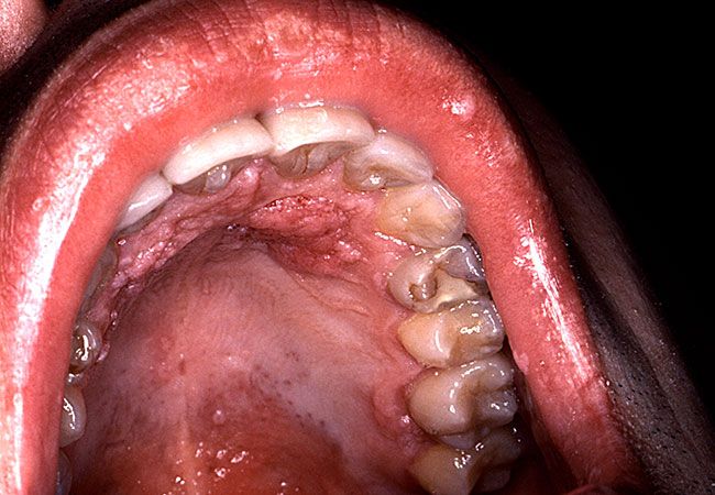 Can oral sex hurt your throat