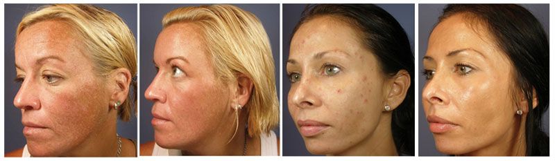 Facial peel recovery