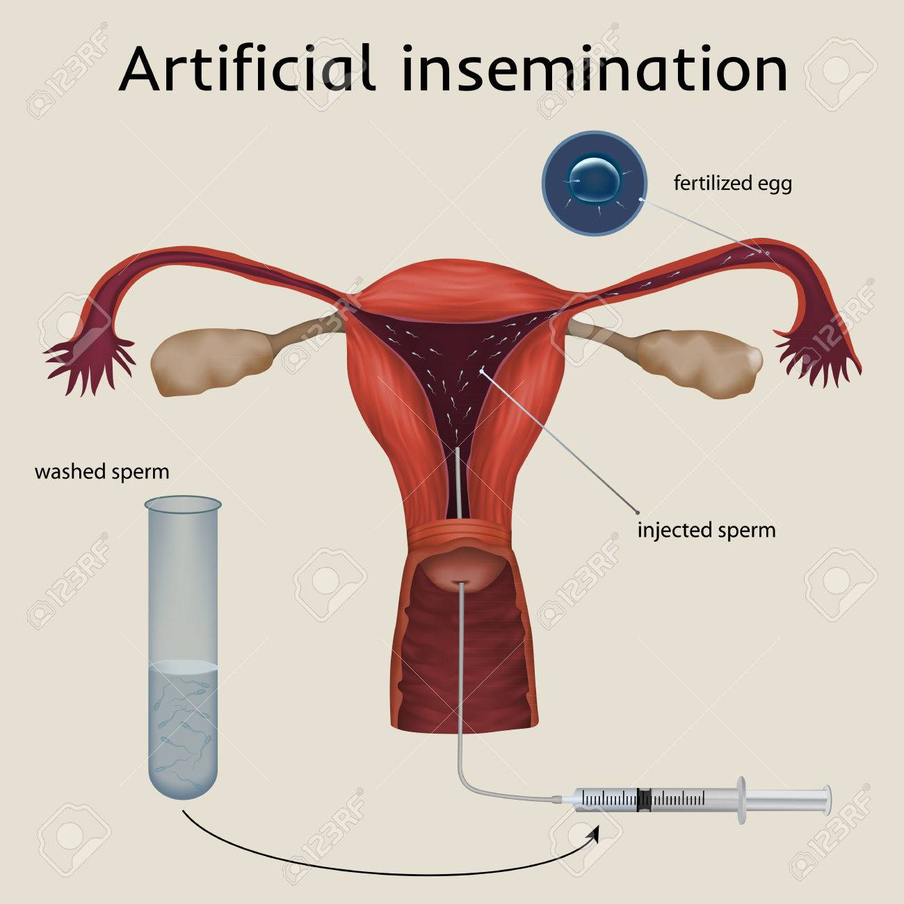 Free sperm for artificial insemination