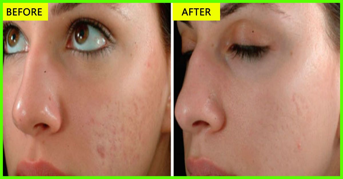Empress reccomend Facial restoration from acne and dark spots