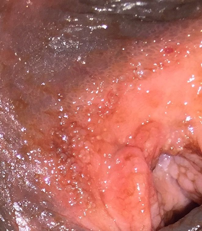 Pictures of bumps on vulva