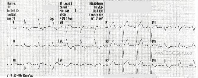 best of Of with bbb strip Ekg rsr