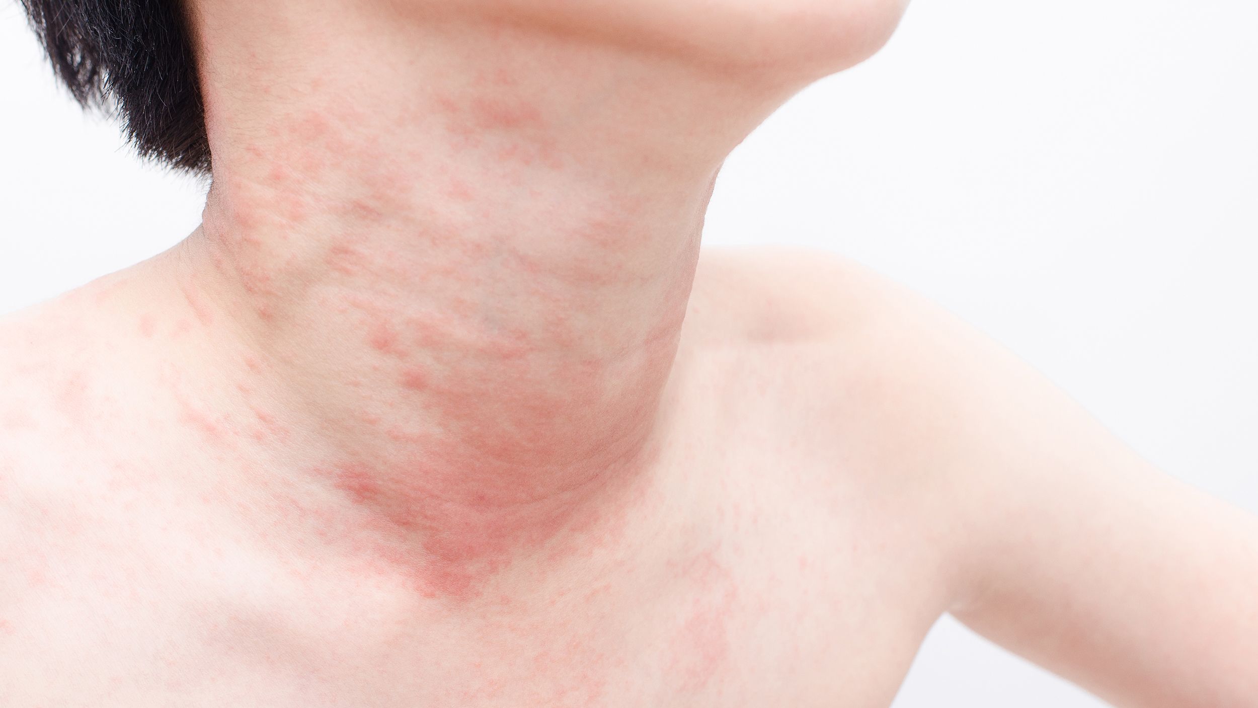 best of Over Adult and chest face rash