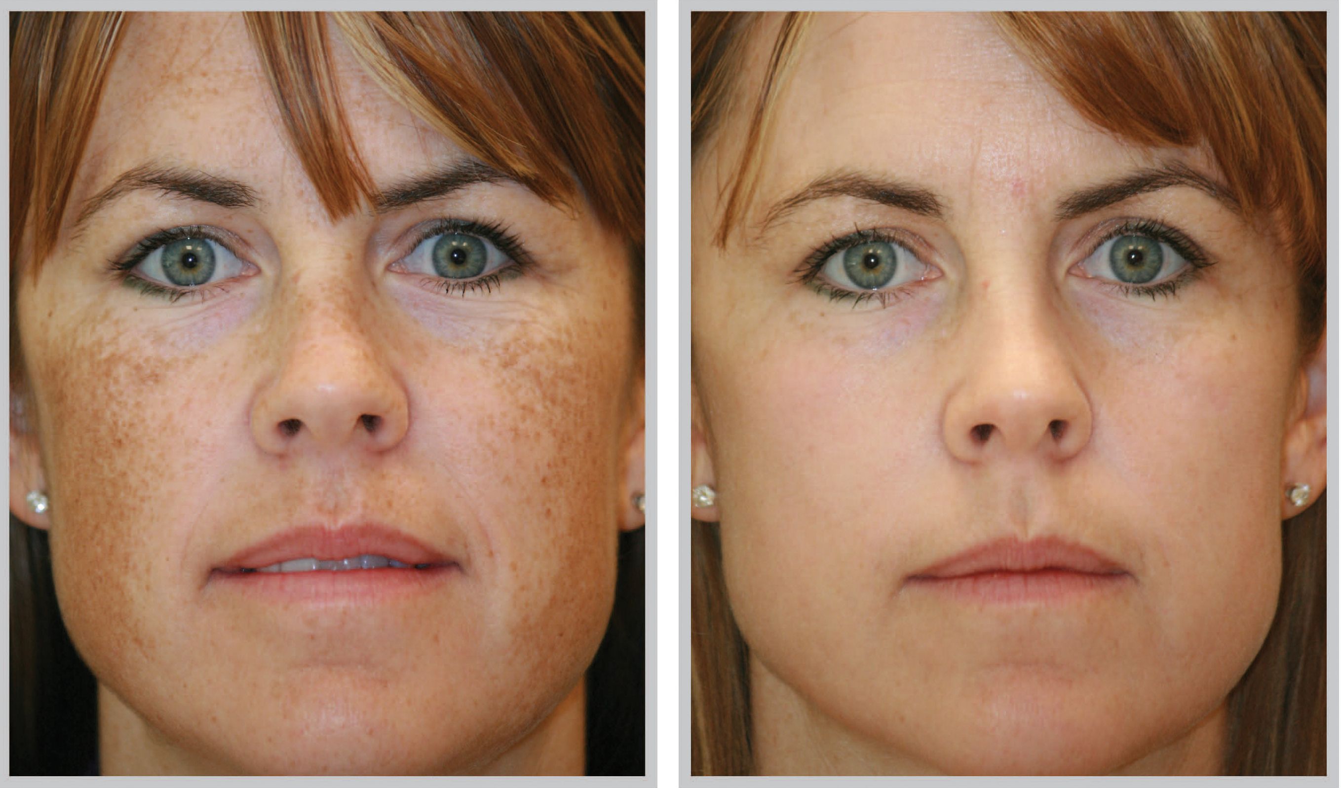 best of Brown spots facial Removing