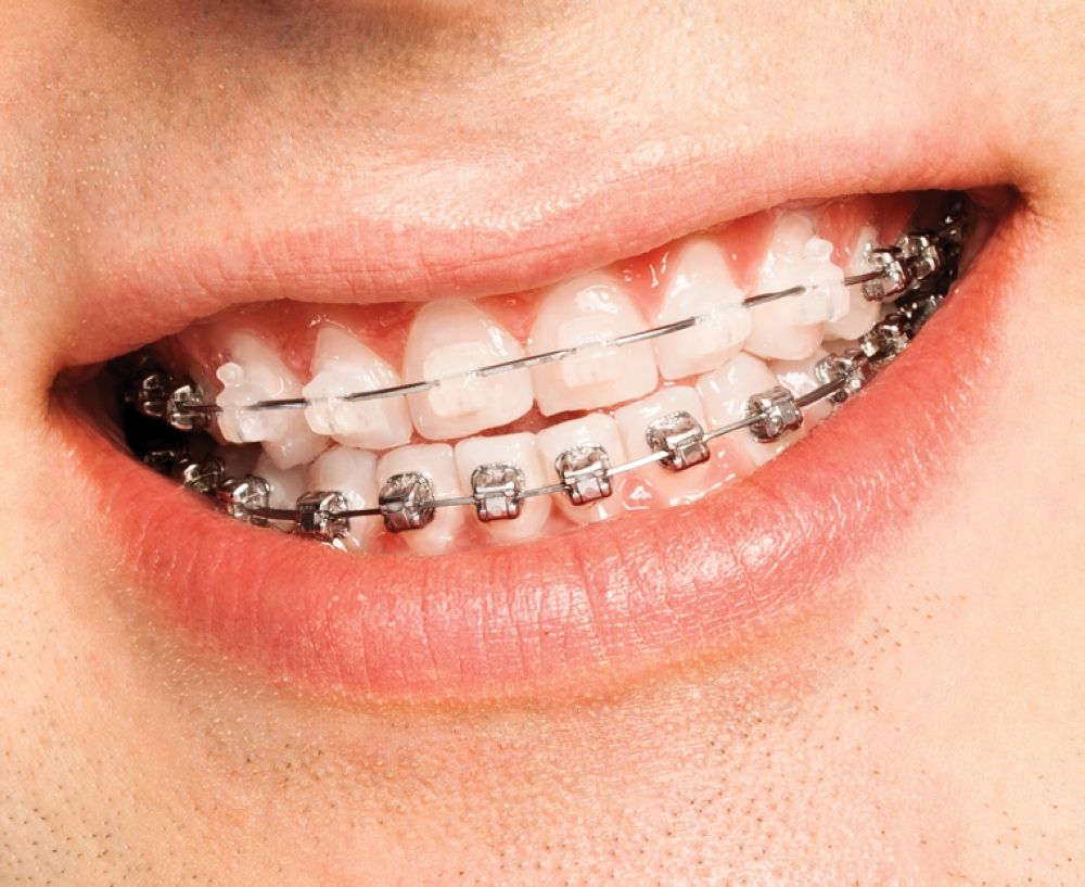 best of Braces Alternatives adults to for