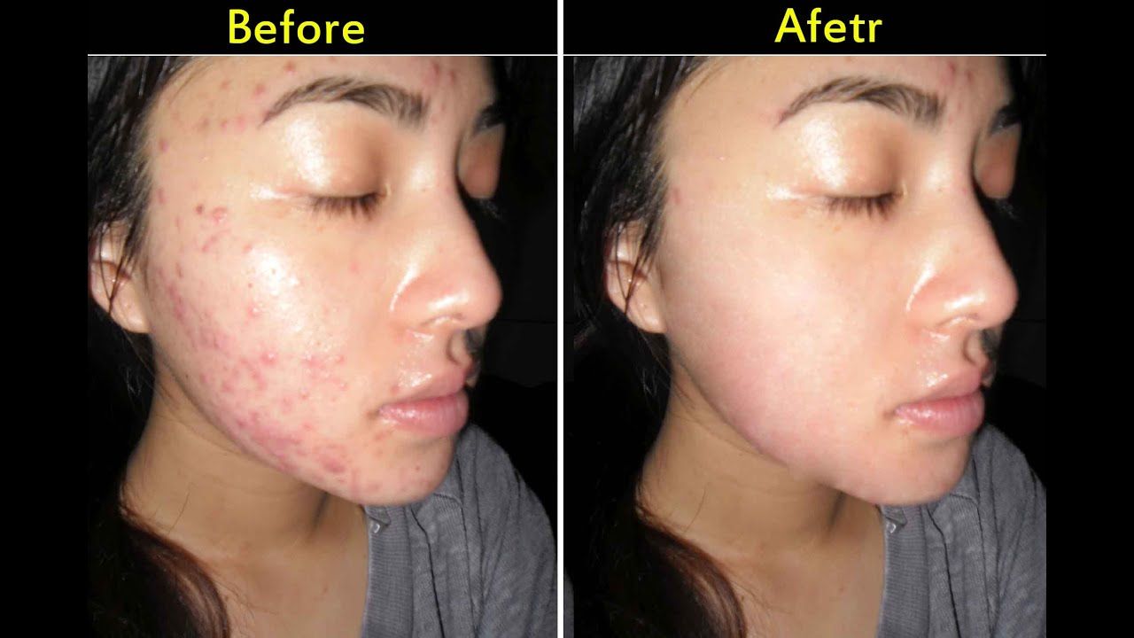 best of Pimple facial Anti
