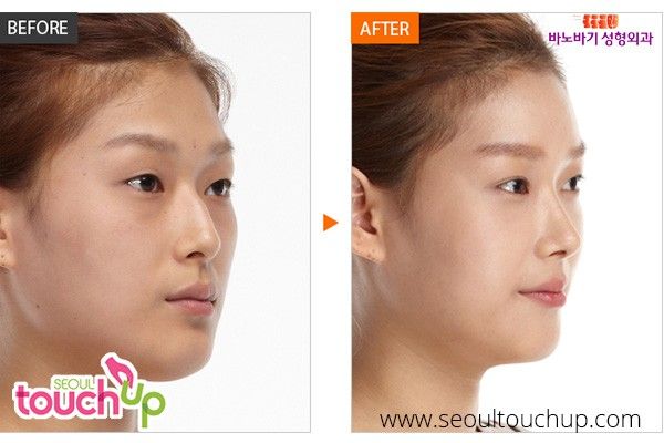 Asian nose surgery implants